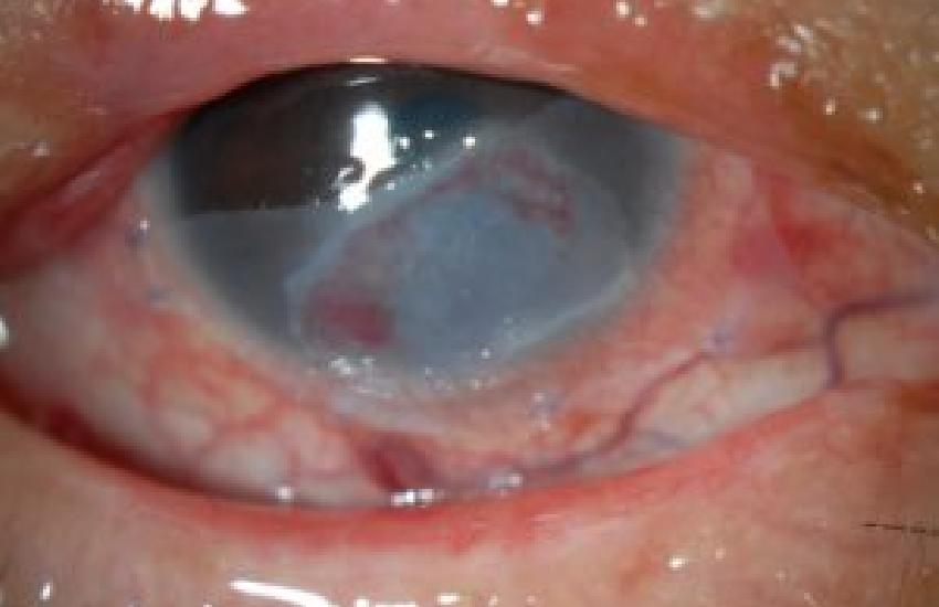 AMNIOTIC MEMBRANE GRAFTING