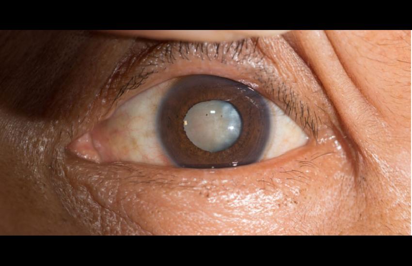 CATARACT SURGERY