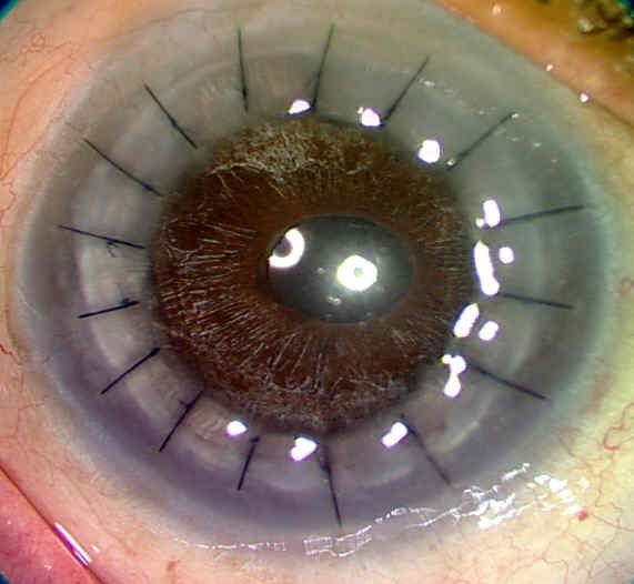 Cornea Transplant Surgery