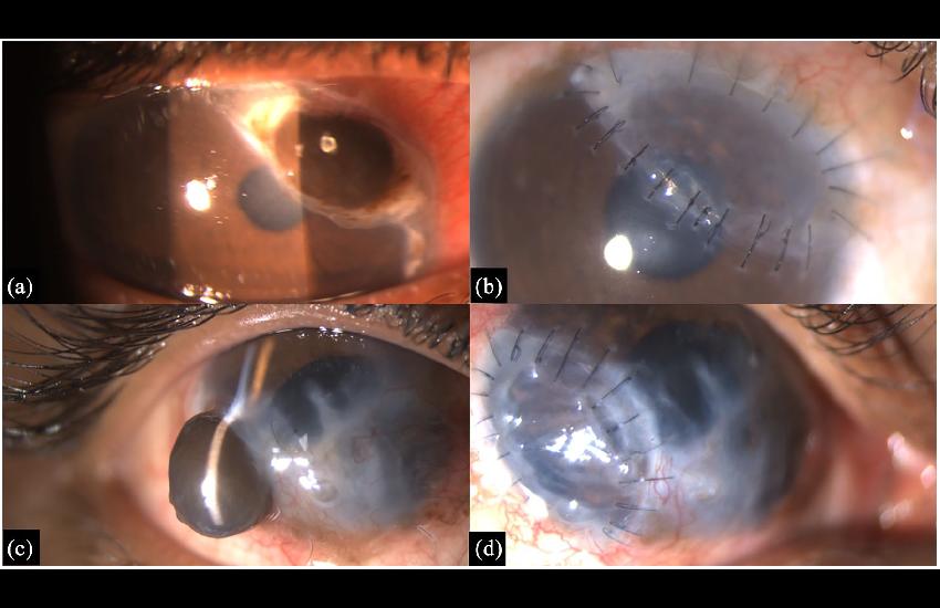 CORNEOSCLERAL PATCH GRAFTING