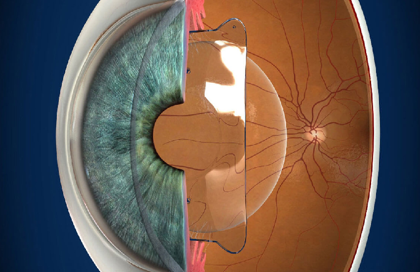 ICL  Procedure