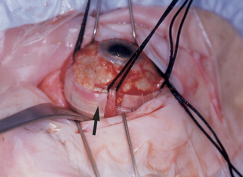Retinal Surgery